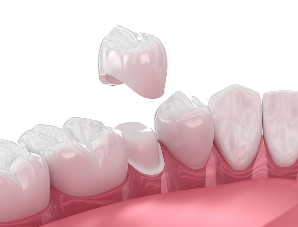 dental crown